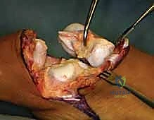 صورة توضيحية لـ عمليات بتر سيم وبويد الدقيقة لعلاج نقص عظم الشظية الخلقي: دليل شامل للمرضى