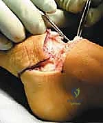 عمليات بتر سيم وبويد الدقيقة لعلاج نقص عظم الشظية الخلقي: دليل شامل للمرضى