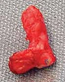 صورة طبية: عمليات بتر سيم وبويد الدقيقة لعلاج نقص عظم الشظية الخلقي: دليل شامل للمرضى