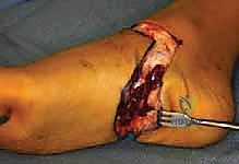 صورة توضيحية لـ عمليات بتر سيم وبويد الدقيقة لعلاج نقص عظم الشظية الخلقي: دليل شامل للمرضى