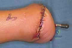 صورة طبية: عمليات بتر سيم وبويد الدقيقة لعلاج نقص عظم الشظية الخلقي: دليل شامل للمرضى