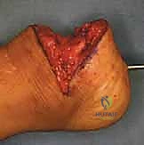 عزل الأوعية الدموية بدقة بالغة