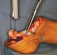 صورة توضيحية لغياب أشعة القدم وتشوه الكاحل