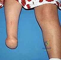 Masterclass: Precision Syme and Boyd Amputations for Congenital Fibular Deficiency