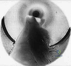 وداعًا لألم القدم المزمن: تخفيف الضغط بالمنظار أحادي المدخل لورم مورتون مع الأستاذ الدكتور محمد هطيف