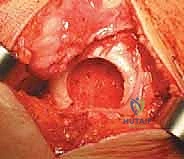 زراعة الطعوم الغضروفية العظمية: حل متقدم لاستعادة غضروف الركبة
