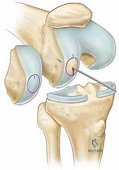 مقارنة تقنيات ترميم الغضروف المفصلي