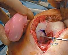 تشريح الركبة والغضروف المفصلي المعقد