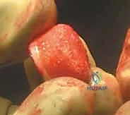 صورة توضيحية لـ زراعة الطعوم الغضروفية العظمية: حل متقدم لاستعادة غضروف الركبة على يد الأستاذ الدكتور محمد هطيف في صنعاء