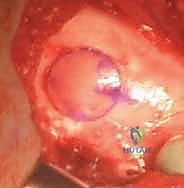 صورة توضيحية لـ زراعة الطعوم الغضروفية العظمية: حل متقدم لاستعادة غضروف الركبة على يد الأستاذ الدكتور محمد هطيف في صنعاء