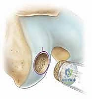 صورة توضيحية لـ زراعة الطعوم الغضروفية العظمية: حل متقدم لاستعادة غضروف الركبة على يد الأستاذ الدكتور محمد هطيف في صنعاء