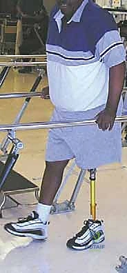 Modular Proximal Femoral Replacement: Reconstructing an Above-Knee Stump After Hip Disarticulation