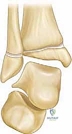 صورة توضيحية لـ تشوه الكاحل الإفحجي (القدم المسطحة): دليل شامل وعلاج بتقنية تعديل النمو الموجه مع الأستاذ الدكتور محمد هطيف