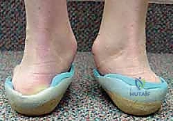 استخدام الدعامات والأحذية الطبية كعلاج تحفظي مبدئي