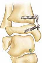 صورة توضيحية لـ تشوه الكاحل الإفحجي (القدم المسطحة): دليل شامل وعلاج بتقنية تعديل النمو الموجه مع الأستاذ الدكتور محمد هطيف