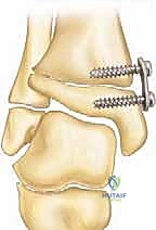 قياسات هندسية دقيقة لتحديد درجة التشوه الإفحجي