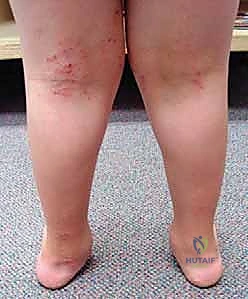 جلسات العلاج الطبيعي والتأهيل الحركي بعد العملية الجراحية