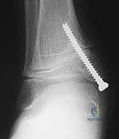 صورة شعاعية توضح الغضروف المشاشي وانحراف الكاحل