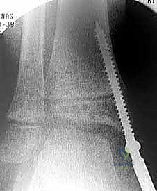 استخدام جهاز الأشعة داخل غرفة العمليات لتحديد مركز النمو