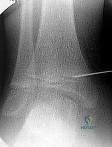 تأثير التشوه على المحور الميكانيكي للطرف السفلي بالكامل