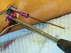 تشوه الكاحل الإفحجي (القدم المسطحة): دليل شامل وعلاج بتقنية تعديل النمو الموجه مع الأستاذ الدكتور محمد هطيف