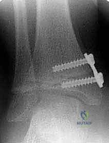 تثبيت شريحة النمو الموجه باستخدام مسامير التيتانيوم