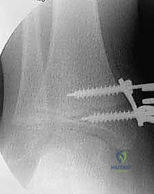 التشريح الميكانيكي الحيوي لمفصل الكاحل وتأثير التشوه