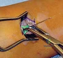 فحص سريري يوضح ميلان الكعب نحو الخارج