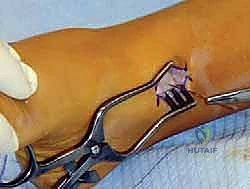 إغلاق الجرح بطريقة تجميلية دقيقة لا تترك أثراً كبيراً