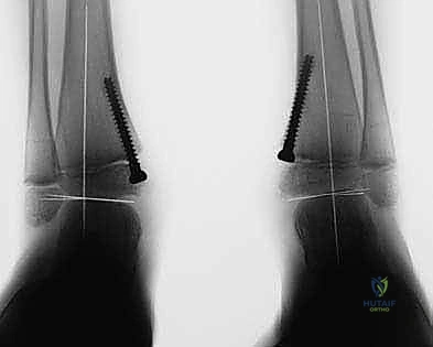 الأستاذ الدكتور محمد هطيف أثناء تقييم حالة تشوه الكاحل الإفحجي