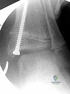 Hemi-Epiphysiodesis for Ankle Valgus: A Masterclass in Guided Growth Modulation
