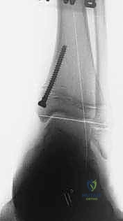 مبدأ عمل تقنية تعديل النمو الموجه باستخدام الشريحة المعدنية