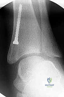 صورة توضيحية لـ تشوه الكاحل الإفحجي (القدم المسطحة): دليل شامل وعلاج بتقنية تعديل النمو الموجه مع الأستاذ الدكتور محمد هطيف