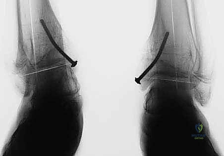 إجراء شق جراحي دقيق وصغير جداً للحفاظ على الأنسجة