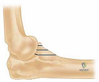 صورة مقطعية توضح تفتت رأس الكعبرة والناتئ الإكليلي