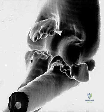 صورة تظهر تمزق الأربطة وإصابة العظام في الثالوث الرهيب