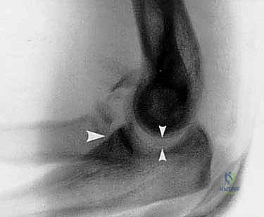 الأشعة السينية تظهر التشوه والخلع في الكوع