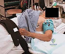 خلع الكوع الكسري المعقد (الثالوث الرهيب): دليل شامل للعلاج والتعافي مع الأستاذ الدكتور محمد هطيف