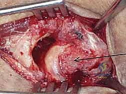 صورة توضيحية لـ خلع الكوع الكسري المعقد (الثالوث الرهيب): دليل شامل للعلاج والتعافي مع الأستاذ الدكتور محمد هطيف