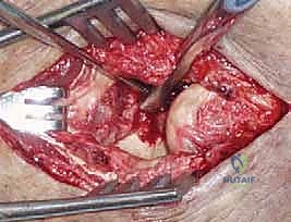 صورة توضيحية لـ خلع الكوع الكسري المعقد (الثالوث الرهيب): دليل شامل للعلاج والتعافي مع الأستاذ الدكتور محمد هطيف