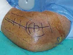 صورة توضيحية لـ خلع الكوع الكسري المعقد (الثالوث الرهيب): دليل شامل للعلاج والتعافي مع الأستاذ الدكتور محمد هطيف