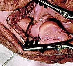 صورة توضيحية لـ خلع الكوع الكسري المعقد (الثالوث الرهيب): دليل شامل للعلاج والتعافي مع الأستاذ الدكتور محمد هطيف