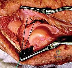 صورة توضيحية لـ خلع الكوع الكسري المعقد (الثالوث الرهيب): دليل شامل للعلاج والتعافي مع الأستاذ الدكتور محمد هطيف