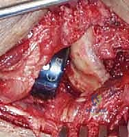 صورة طبية: خلع الكوع الكسري المعقد (الثالوث الرهيب): دليل شامل للعلاج والتعافي مع الأستاذ الدكتور محمد هطيف