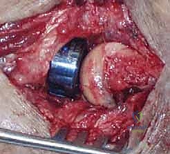 صورة توضيحية لـ خلع الكوع الكسري المعقد (الثالوث الرهيب): دليل شامل للعلاج والتعافي مع الأستاذ الدكتور محمد هطيف