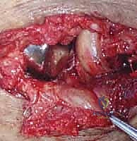 صورة طبية: خلع الكوع الكسري المعقد (الثالوث الرهيب): دليل شامل للعلاج والتعافي مع الأستاذ الدكتور محمد هطيف