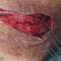 صورة طبية: خلع الكوع الكسري المعقد (الثالوث الرهيب): دليل شامل للعلاج والتعافي مع الأستاذ الدكتور محمد هطيف