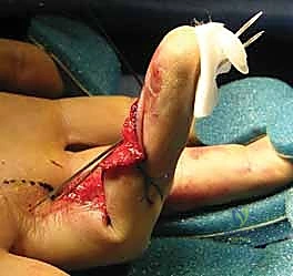 DIP Joint Fracture-Dislocations: An Intraoperative Masterclass