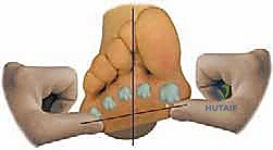 تقييم مرونة القدم وتحديد درجة التشوه الثابت في العيادة