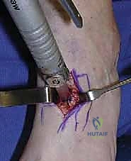 جراحة كوتون (Plantarflexion Osteotomy): حل متقدم لتشوه القدم المسطحة في صنعاء مع الأستاذ الدكتور محمد هطيف